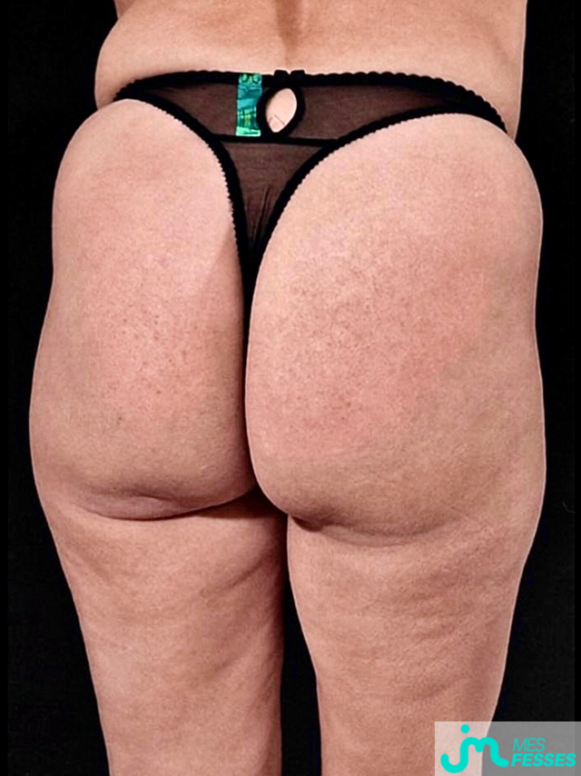 fesses de Aristobule
